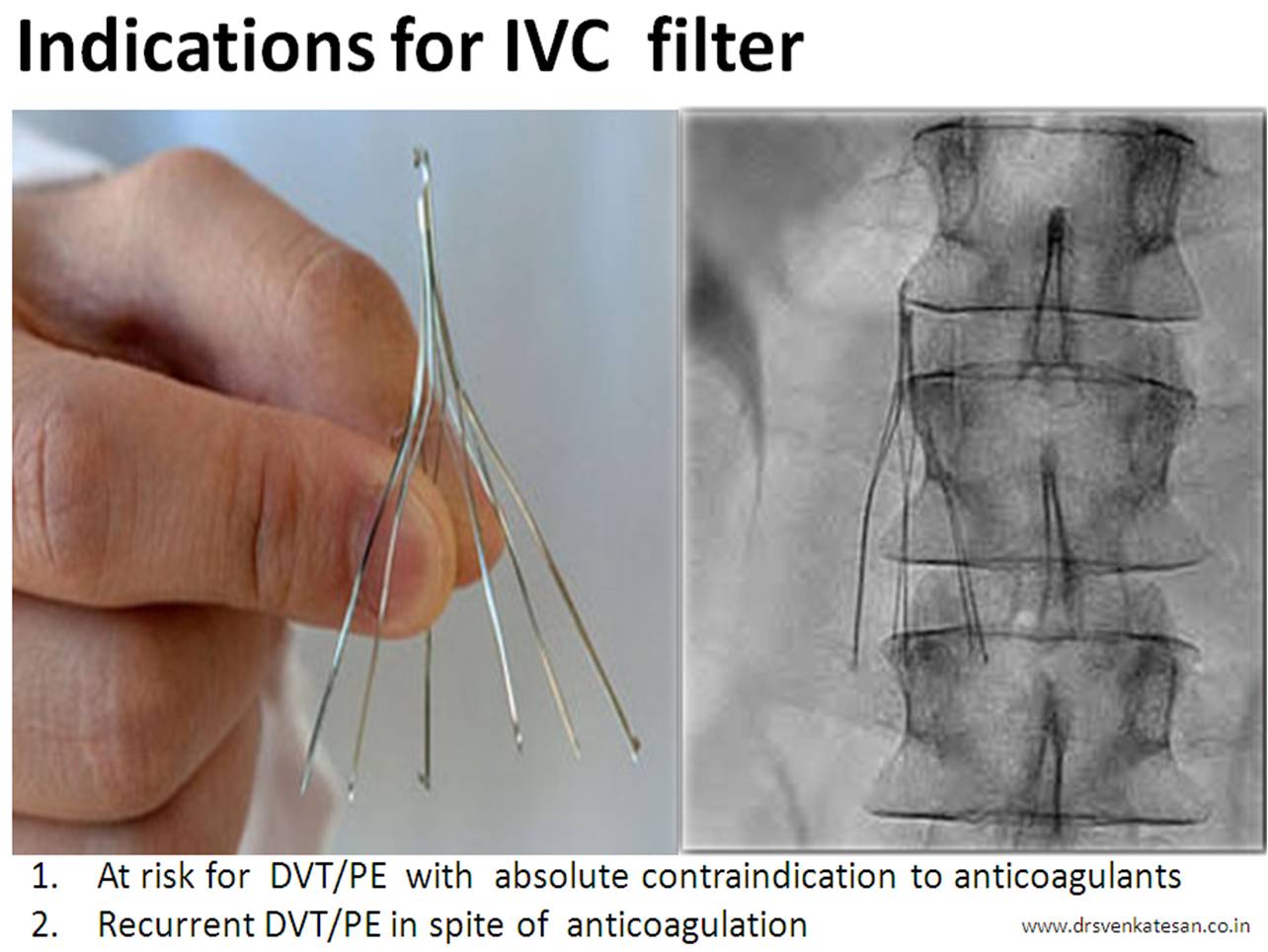indication-for-iv-filter-prepic-study